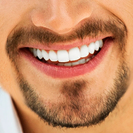 Depilación Láser Masculina en Barba Candado